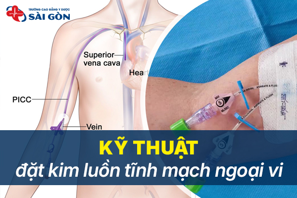 Kỹ thuật đặt kim luồn tĩnh mạch ngoại vi: Mục đích, quy trình và lưu ý