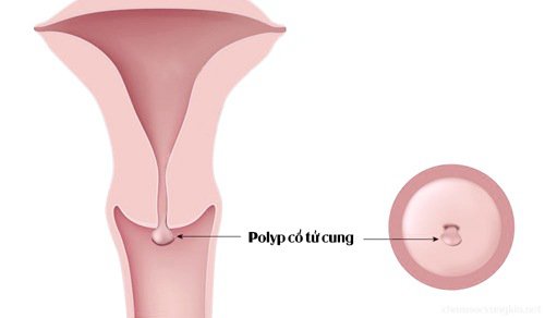 Tìm hiểu về bệnh lý Polyp tử cung 2