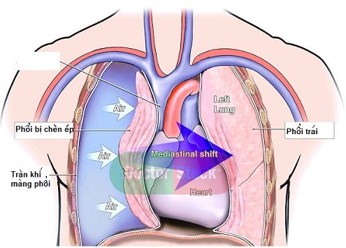 Tràn khí màng phổi là bệnh gì? Tìm hiểu nguyên nhân gây bệnh 1