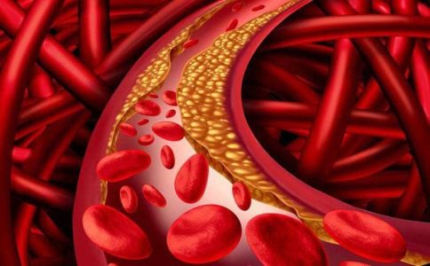 Tìm hiểu các biện pháp ngăn ngừa mỡ máu hiệu quả